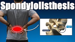 Lumbar Spondylolisthesis (Best Exercises, Rehab, Advice & Myth Busting for Back Pain Relief)