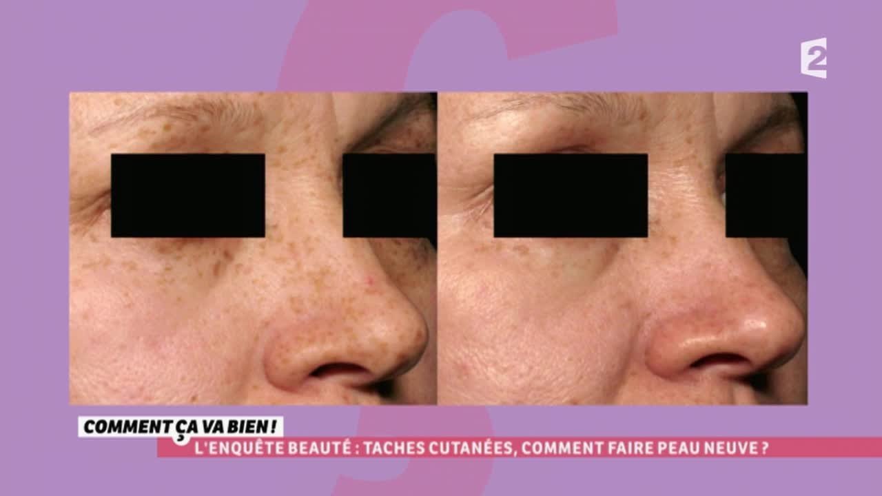 [BEAUTÉ] Tâches cutanées, comment faire peau neuve ? #CCVB - YouTube