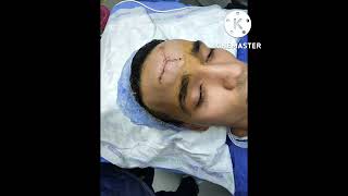 عملية تجميل و ازالة الندبات / تحسين اثار جروح الوجه جراحيا scar face  / ا. د. صابر عبد  المقصود