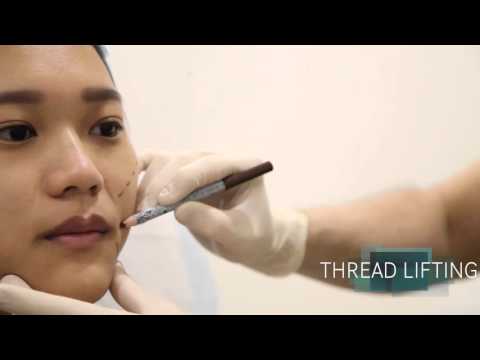 THREAD LIFTING