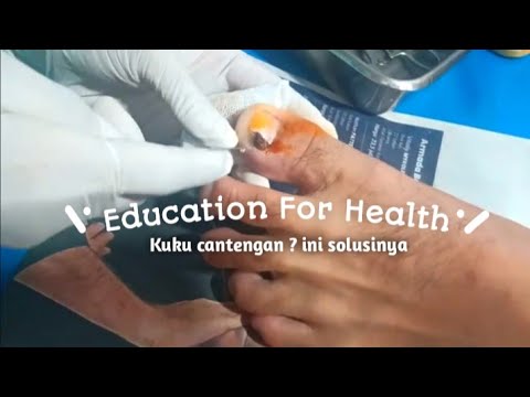 Pencabutan Kuku Kaki ~ Menghilangkan rasa nyeri dan infeksi pada kuku