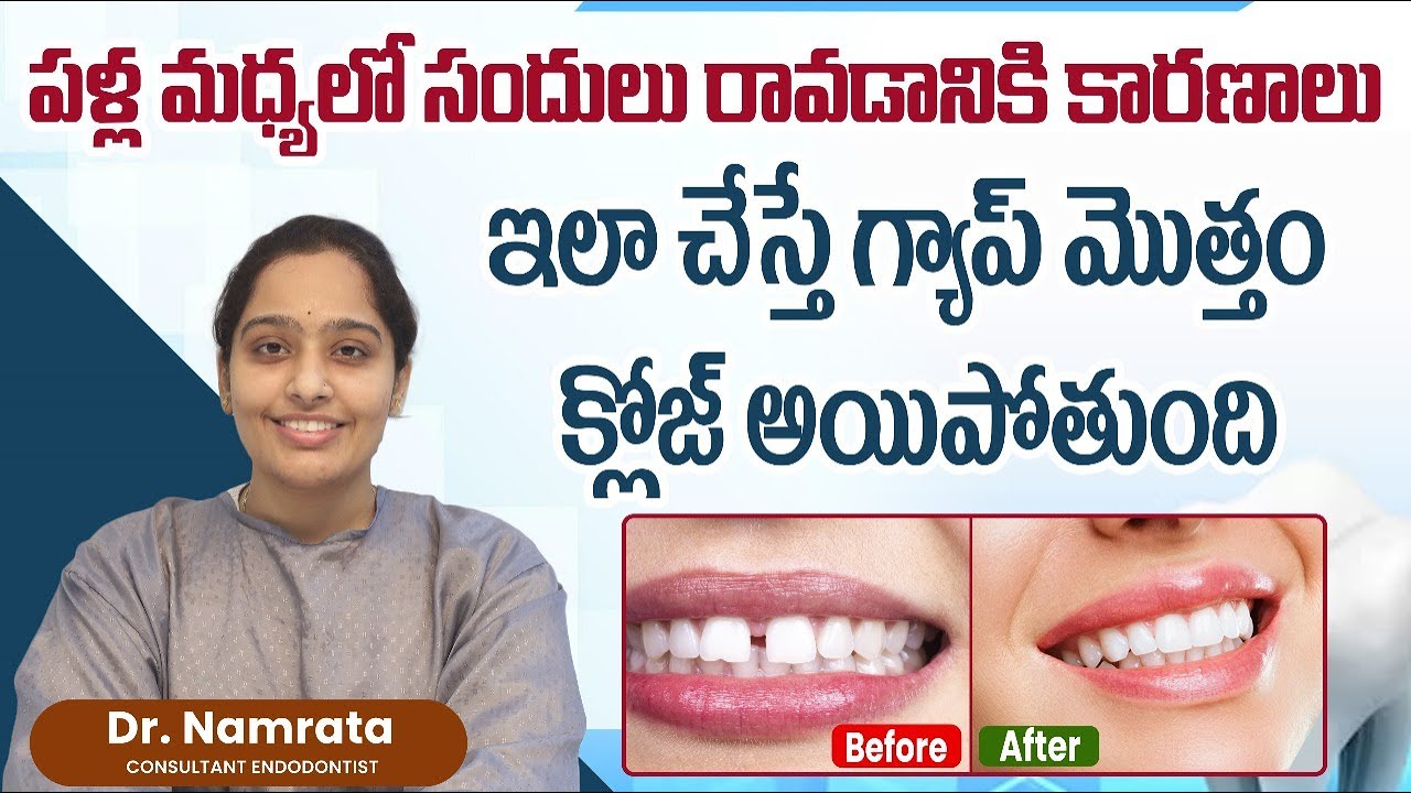 పళ్ల మధ్యలో సందులు రావడానికి కారణాలు | How To Fill Gaps Between Teeth | Eledent Dental Hospitals