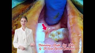 Odontectomy (Bedah Gigi Tidur)