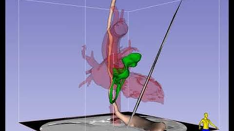 Transgastric Mid-Papillary Short-Axis Imaging Plane in TEE - Standard View