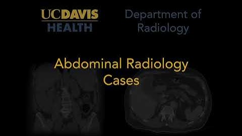Hepatofugal flow of the portal vein on ultrasound