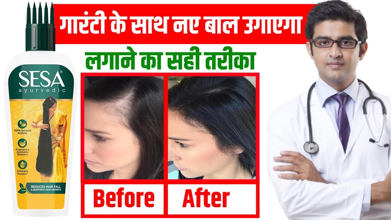 Sesa Ayurvedic Hair Oil Review गंजापन जड़ से खत्म करेगा How To Use