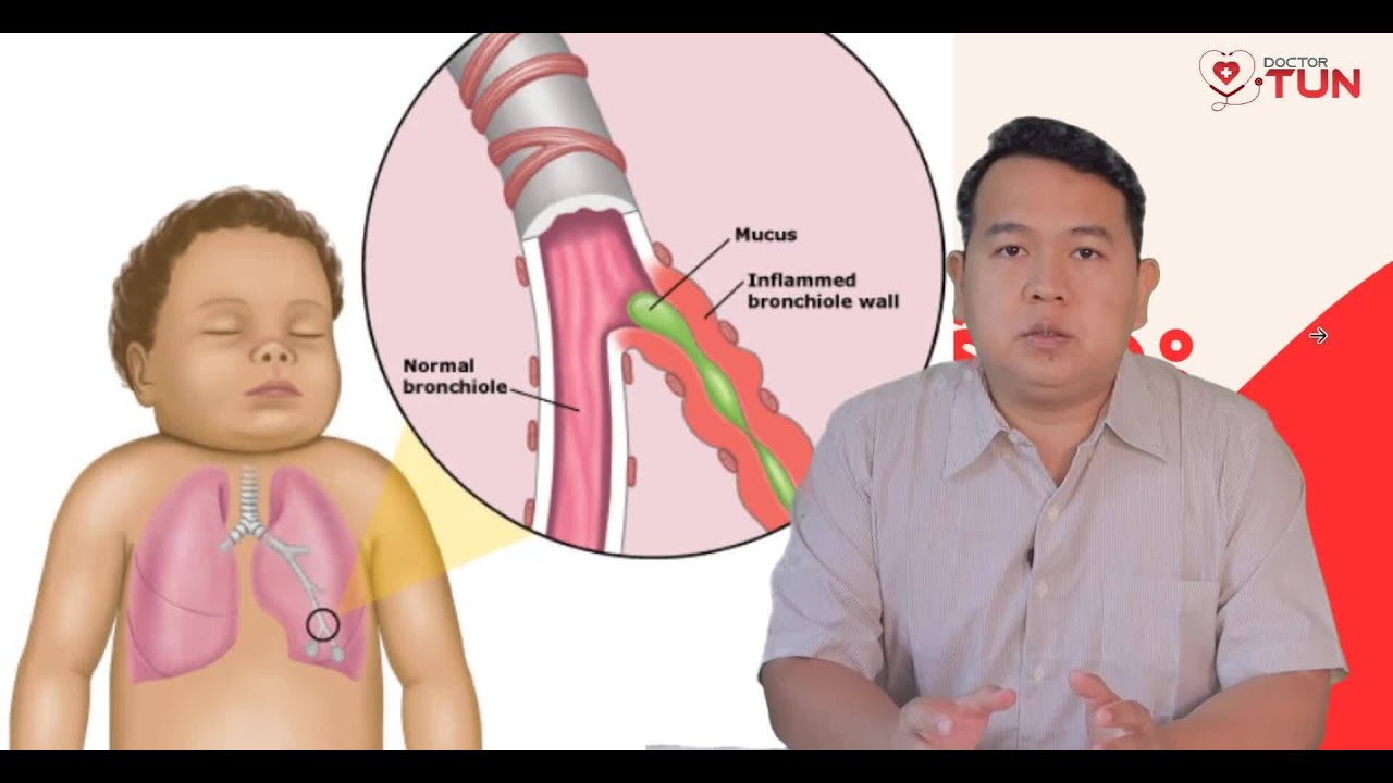 ဆောင်းရာသီမှာ ဖြစ်တတ်တဲ့ အဆုတ်လေပြွန်မွှားရောင်ရောဂါ