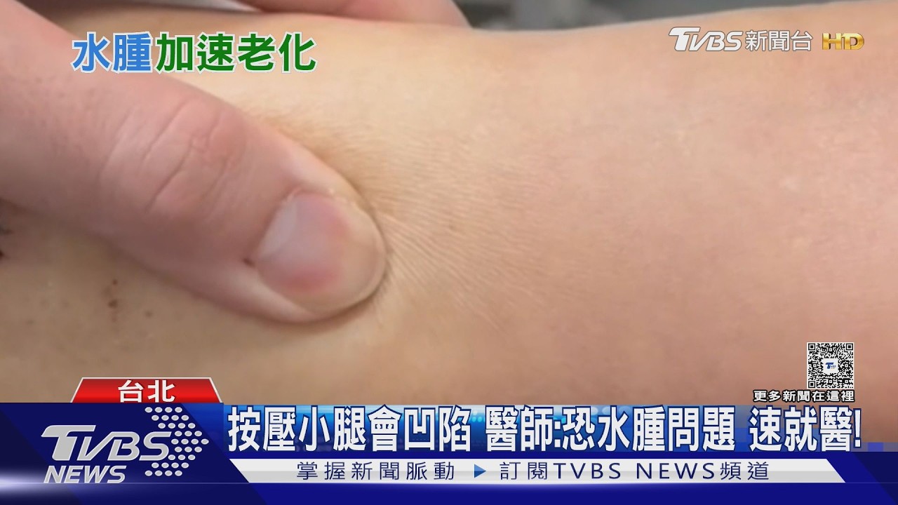 水腫不是變胖! 醫揭心.肝.腎警訊 出現「這症狀」勿輕忽｜十點不一樣20260512 @TVBSNEWS01