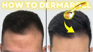 How to Derma Roll for Quickest Hair Results (StepbyStep Guide)