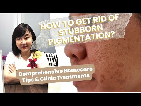 Causes, Types & Removal Methods of Pigmentations Explained in One Video