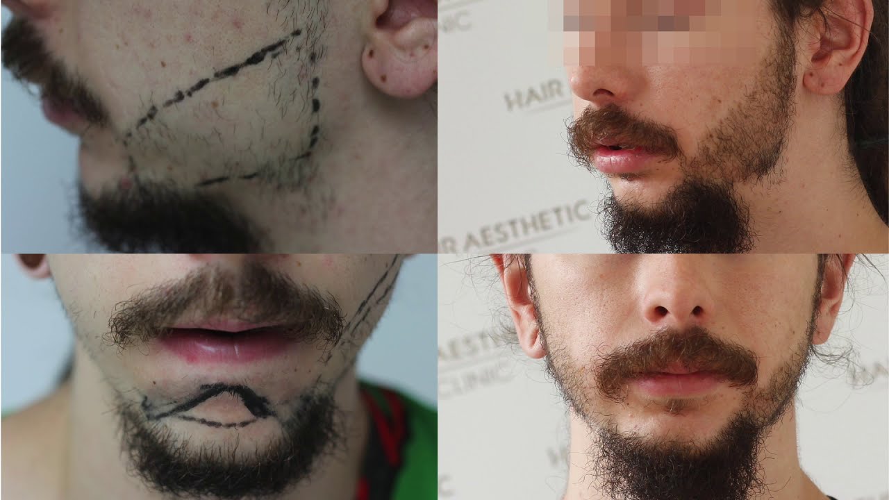 Beard Transplant FUE (1400 Grafts) Result Only 1 Month / BeforeAfter