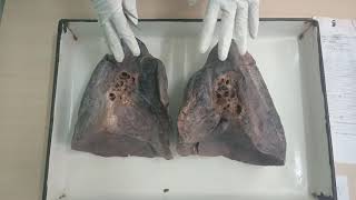 Lungs side determination in 10 seconds ! Root of the lung! Trick! For Spotting Purpose screenshot 5