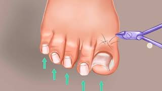 Ingrown Toe Nail Care Animated Video