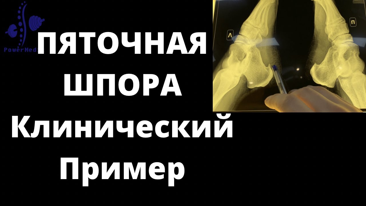 ПЯТОЧНАЯ ШПОРА | Плантарный Фасциит | ЛЕЧЕНИЕ, ДИАГНОСТИКА, КЛИНИКА