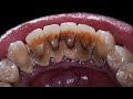Patient’s first time to have a dental cleaning | Scaling