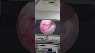 Full Endoscopic Spine Surgery #psld #endoscopicspinesurgery #endoscopicspinesurgery