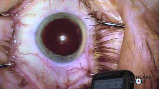 An Eye Surgery Breakthrough