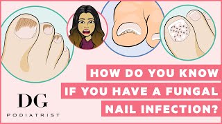 How do you know if you have a fungal nail infection?