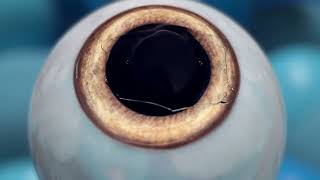 EVO Visian ICL Animated Surgical Procedure