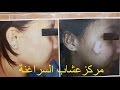 علاج البهاق في مركز عشاب السراغنة  