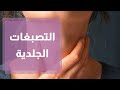 التصبغات الجلدية على الرقبة وتحت الابط التصبغات الجلدية على الرقبة وتحت الابط