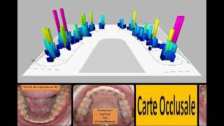 Orthognator and T-Scan