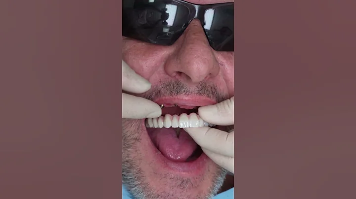 Dental implant’s All on 4 v Praze #shorts #dentist #dental #implant #veneers #short