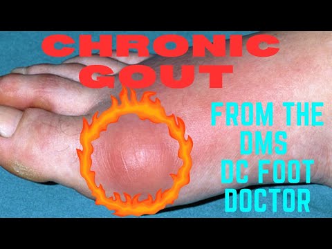 Chronic Gout: From