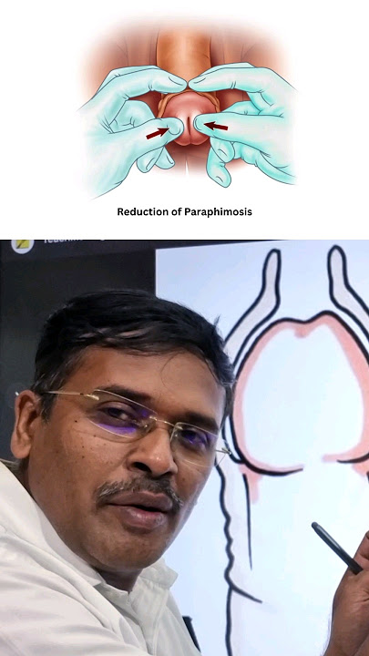 ஆண்குறி முன் தோல் பிரச்சினைகள் !? #doctorkarthikeyan