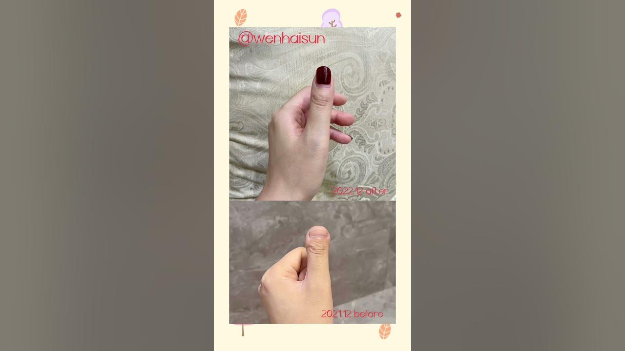 Brachydactyly type D, toethumbs, clubbed thumbs, stubby thumbs brachydactyly 