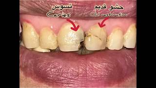 Composite veneer /حالة تجميل اسنان