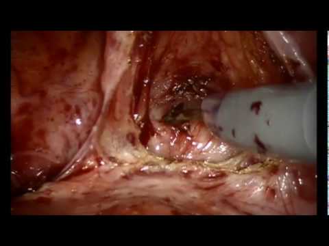 Robotic Assisted Laparoscopic Hysterectomy