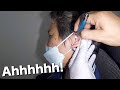 Woman&#39;s Huge Earwax Removed Using Lighted Ear Curette