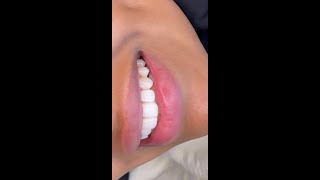 الفنانة ألاء الهندي وإبتسامة هوليود الجديدة وقصة خوفها من دكتورالاسنان وتجميل الاسنان