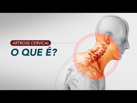 Vídeo: 3 maneiras de saber se você tem espondilose