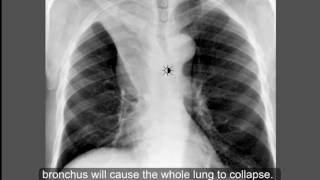 Respiratory System - Chest Conditions- Atelectasis - Part 1