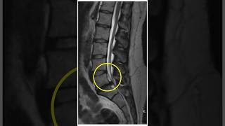 Lumbar Disc Extrusion recovery at home sciatica discextrusion backpain sciaticapainrelief l4l5