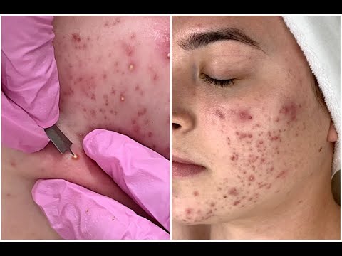 Acne Scars & Blemish Brightening + Clearing Facial | Jadeywadey180