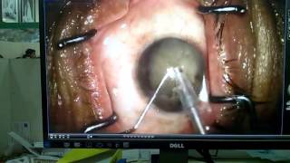 Video thumbnail of "Phaco Emulsification Operation LIVE || Phaco Eye Surgery"