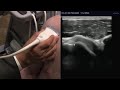 Sonography of shoulder