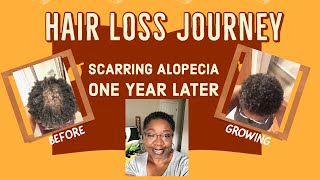 Hair Loss Journey - One Year Later