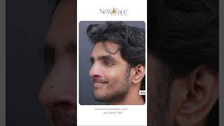 Rhinoplasty in India | Natural Nose Reshaping Surgery by Dr. Mathew PC | Newface Kerala #drmathewpc