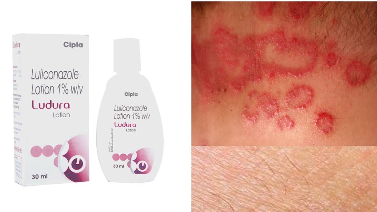 Ludura lotion dad kaj kujli ki number one medicine ll