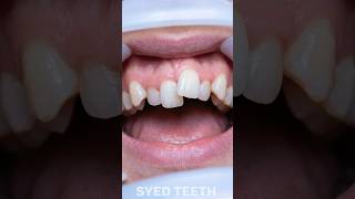 Extreme Crooked Teeth Fix 😱 Full Braces Treatment | Straight Teeth Result