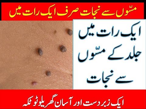 Remove skin tags in 1 night|جلد کے مسے ایک رات میں ختم