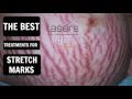 how to treat stretch marks
