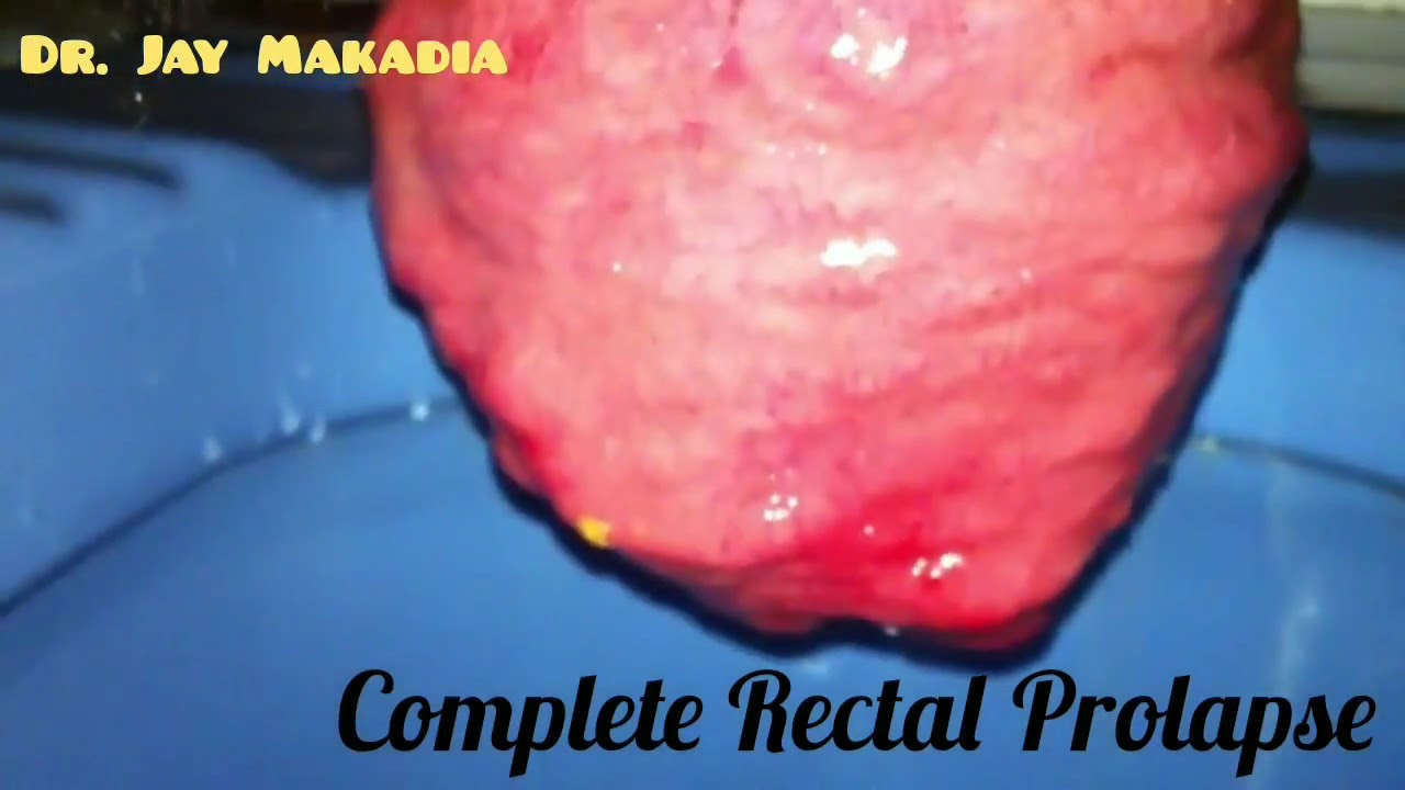 Weightlifter Rectal Prolapse