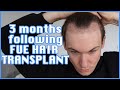 FUE Hair Transplant | Month 3 | Surgery, Swelling, Growth, Before & After, Advice | Progress Update