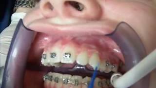 Repositioning brackets at Dr. David Markowitz orthodontic office Update