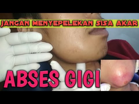 Di video ini menjelaskan tentang animasi otot yang bekerja di rahang bawah Nyeri otot rahang bawah d. 